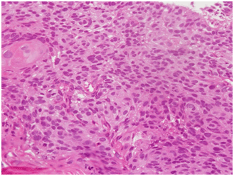 Squamous cell carcinoma of the skin